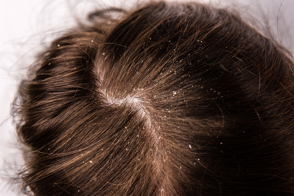التهاب الجلد الدهني في فروة الرأس: الأسباب والعلاجات