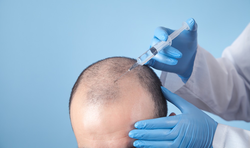 تساقط الشعر عند الرجال: الأسباب، وطرق العلاج
