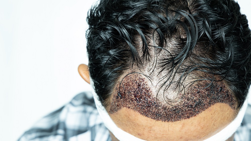 الدليل الشامل حول عملية زراعة الشعر