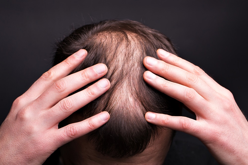 تساقط الشعر عند الرجال: الأسباب، وطرق العلاج
