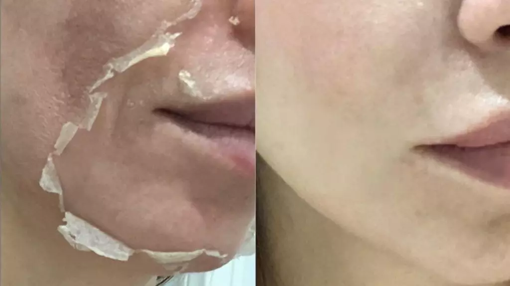 علاج تصبغات الوجه