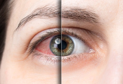 eye contact lenses side effects