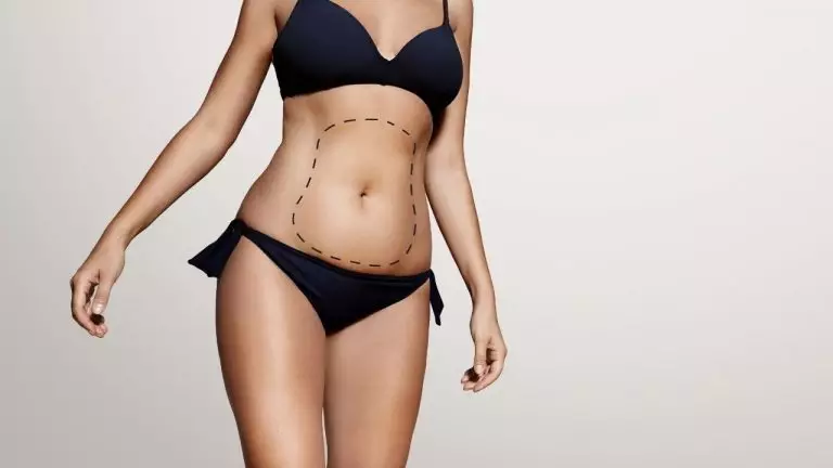 corset after liposuction